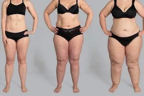 Tres mujeres con diferentes niveles de acumulación en las piernas